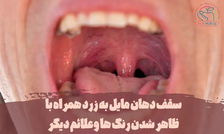 سقف دهان مایل به زرد همراه با ظاهر شدن رنگ ها وعلائم دیگر