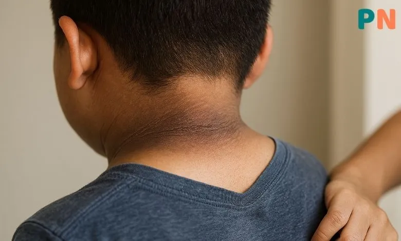 تیرگی پوست در دیابت