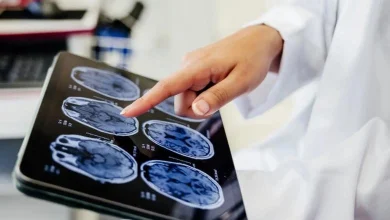 Huntington’s disease