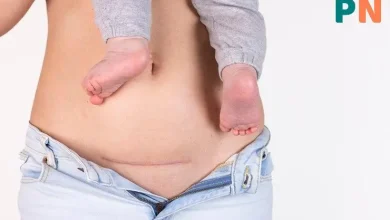 مراقبتهای بعد از سزارین