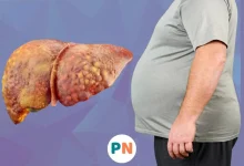 درمان فوری کبد چرب