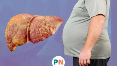 درمان فوری کبد چرب